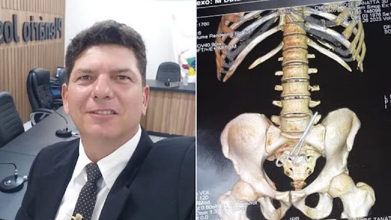 Vereador de MT passa por cirurgia para retirada de tesoura esquecida em seu abdômen