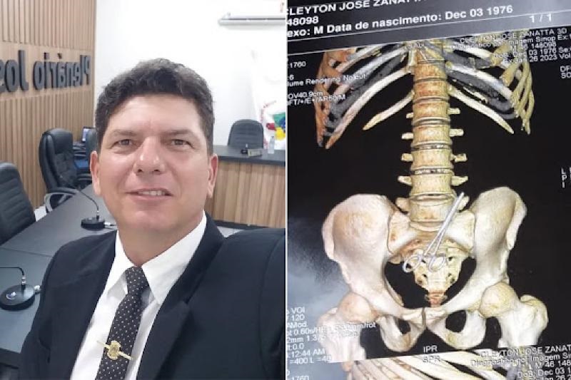 Vereador de MT passa por cirurgia para retirada de tesoura esquecida em seu abdômen