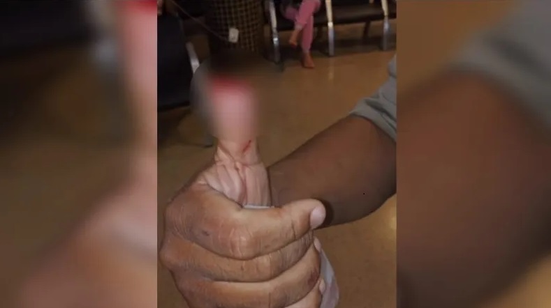 Mulher arranca parte do dedo polegar de policial com mordida durante abordagem