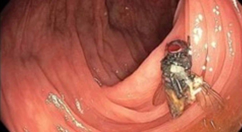 Em caso raríssimo, médicos descobrem mosca viva e intacta dentro do intestino de idoso