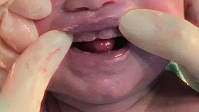 Bebê nasce com dentes e surpreende família e equipe médica